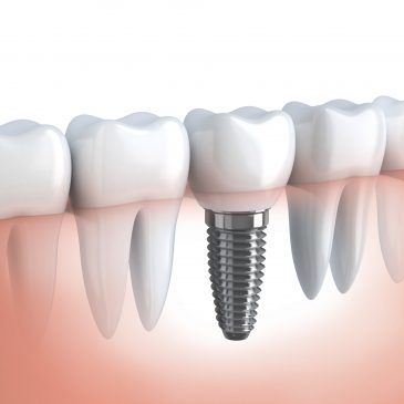 Are Dental Implants Covered by Health Insurance in Houston?